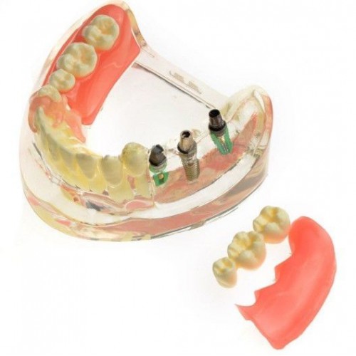 Modelo dental M-6006 Restauración de implantes