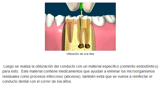 tratamiento de conducto