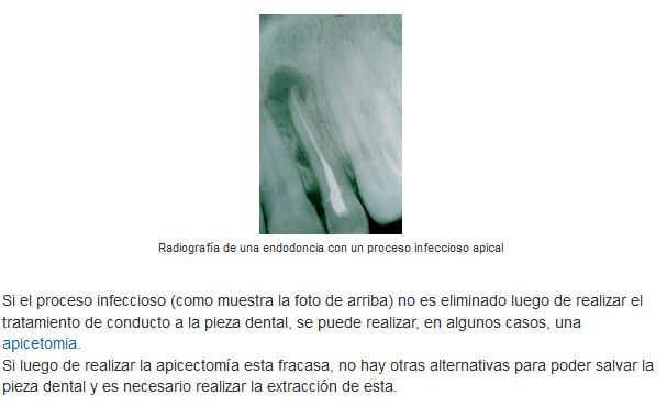 Qué es un tratamiento de conducto o endodoncia