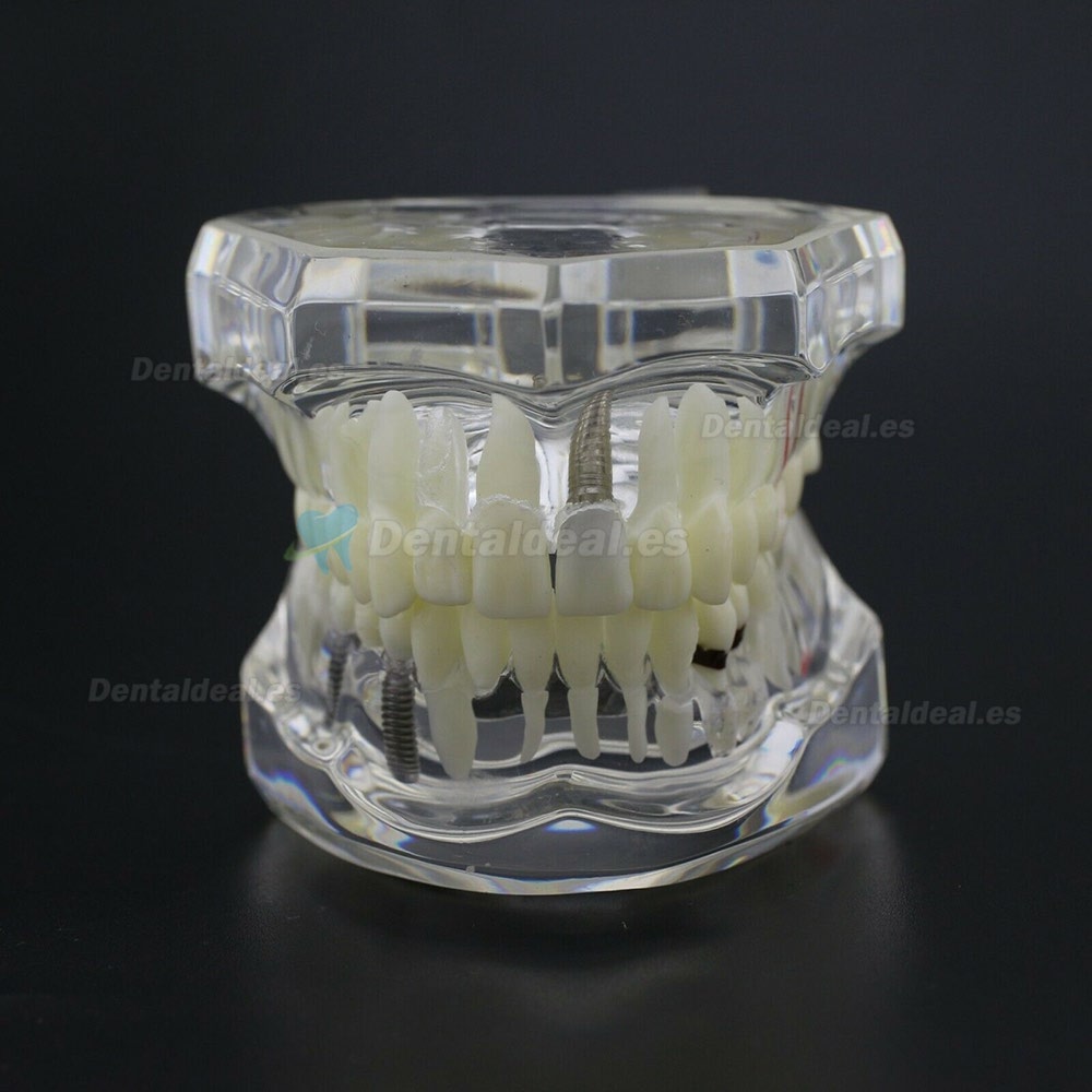 Dientes Dentales Enfermedad Modelo Implante Demostración Caries Periodoncia Transparente Rosa