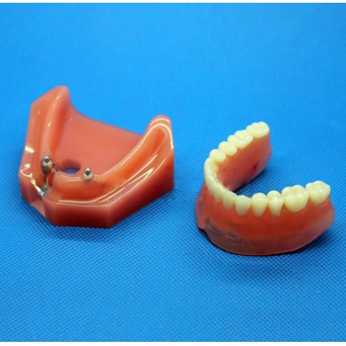 Dental Impant Modelo Para Reparación M-6007