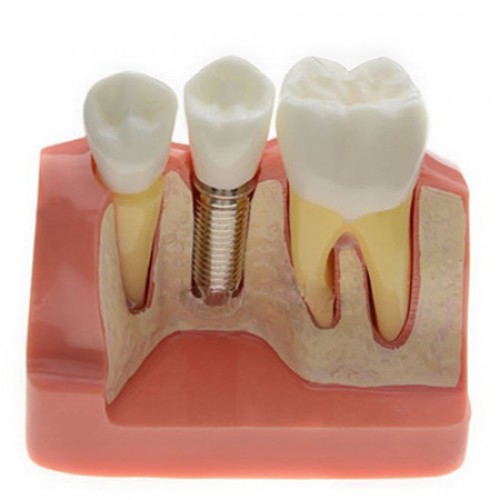 Analysis Modelo Para Dental Implant M2017