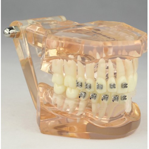 Dental Orthodontic Modelo Con Brackets M3009