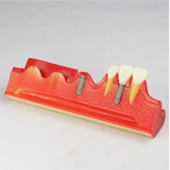 Dental Implant Demonstration Show Modelo M2018