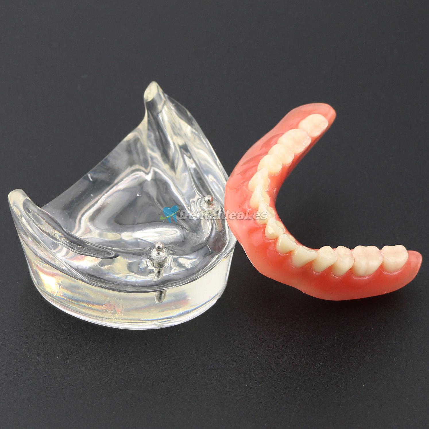 Dental Dientes inferiores Modelo de sobredentadura 2 Implantes Demostración Modelo 6002 01
