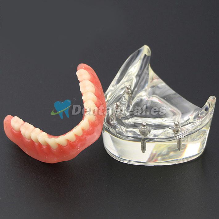 Dientes inferiores dental Modelo de sobredentadura 4 implantes Demostración Modelo 6002 02