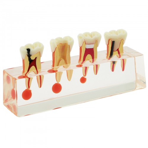 Modelo de Dientes Dentales Estudio de Tratamiento Endodóntico en 4 Etapas Modelo de Enseñanza 4018 01