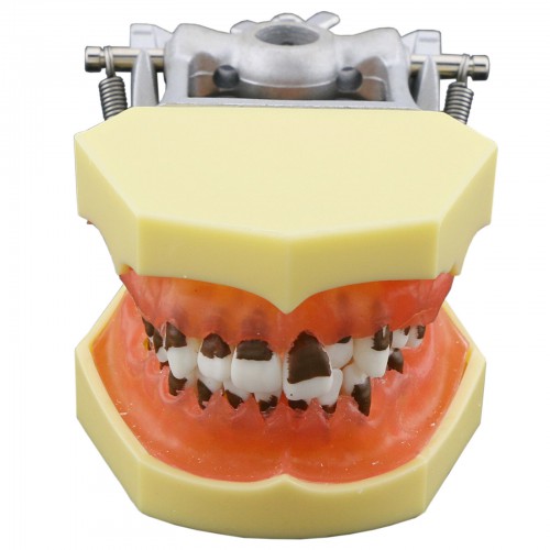 Modelo de enfermedad de periodontosis dental demuestra inflamación gingivale calculs 4003