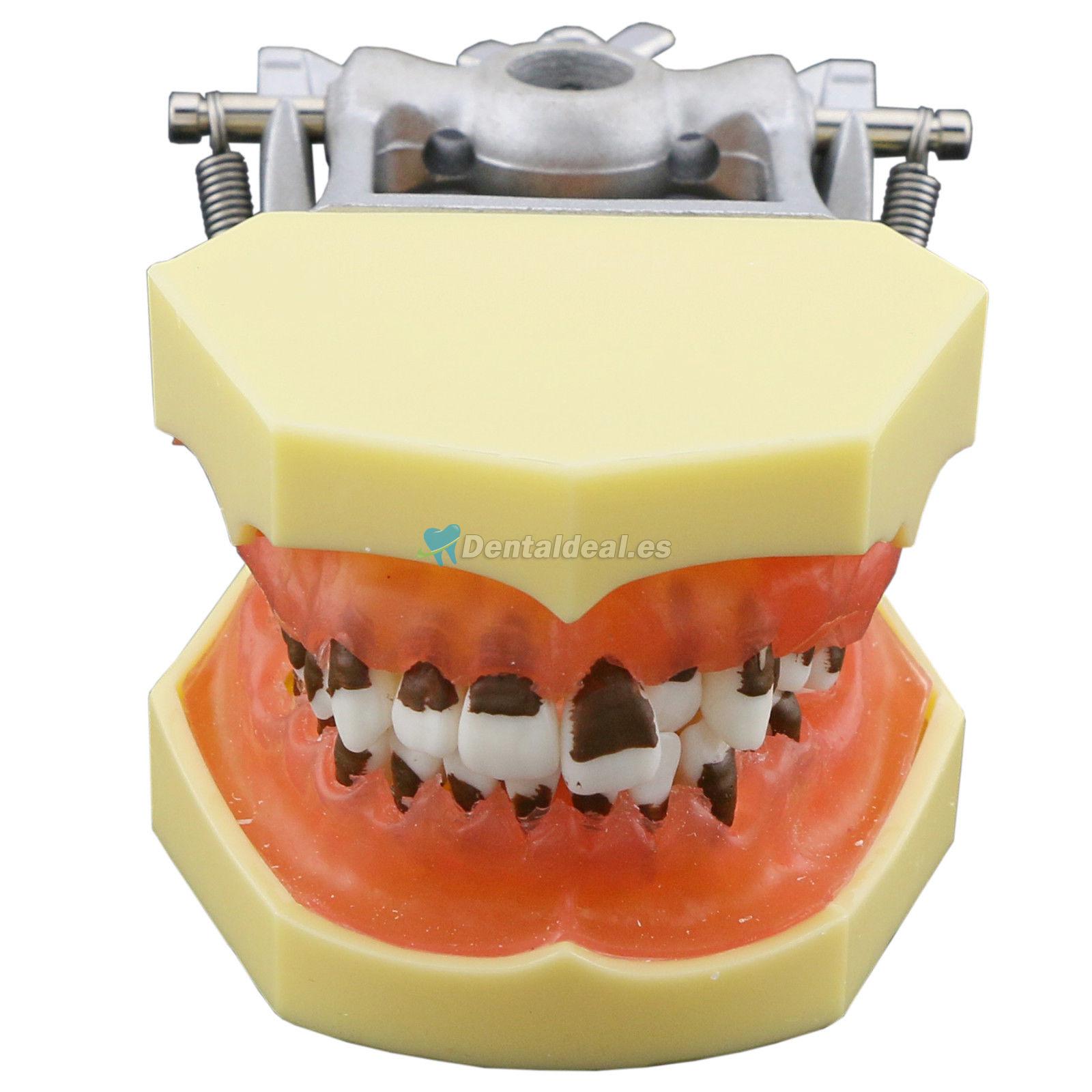 Modelo de enfermedad de periodontosis dental demuestra inflamación gingivale calculs 4003