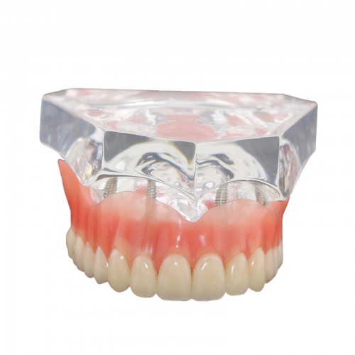 Diente dental Modelo de sobredentadura para implantes de 4 implantes Modelo 6001 02
