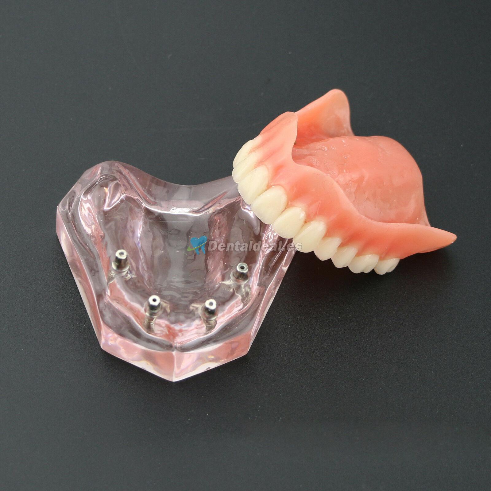 Dental 4 implantes Demostración Modelo de sobredentadura 6001 01