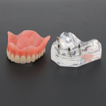 Modelo de dientes de estudio dental sobredentadura con 4 implantes modelo de demostración 6001