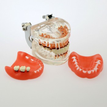 Modelo dental Estudio de la enfermedad periodontal patológica en adultos Modelo de dientes 4017