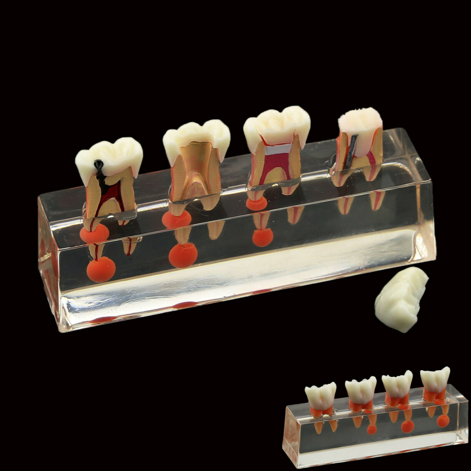 Modelo de dientes dentales El tratamiento endodóntico de 4 etapas demuestra el modelo anatómico M4018-01