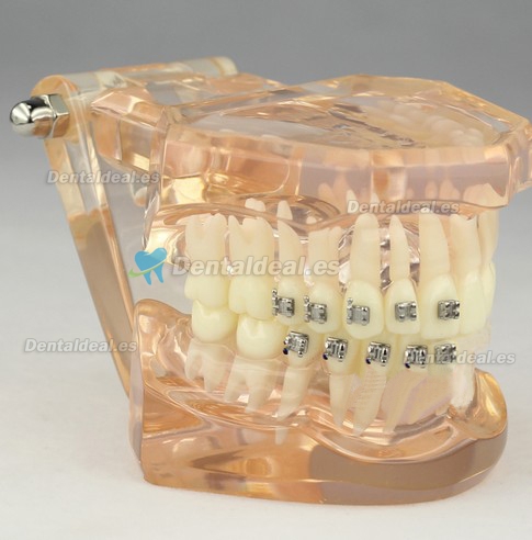 Dental Orthodontic Modelo Con Brackets M3009