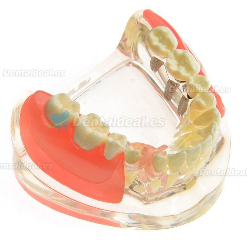 Contraste modelo dental Implante de Restauración de Missing los molares M-6006