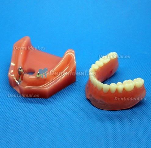 Dental Impant Modelo Para Reparación M-6007