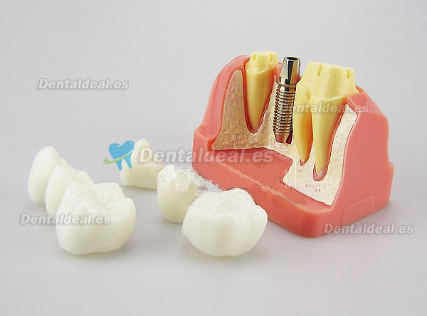 Analysis Modelo Para Dental Implant M2017