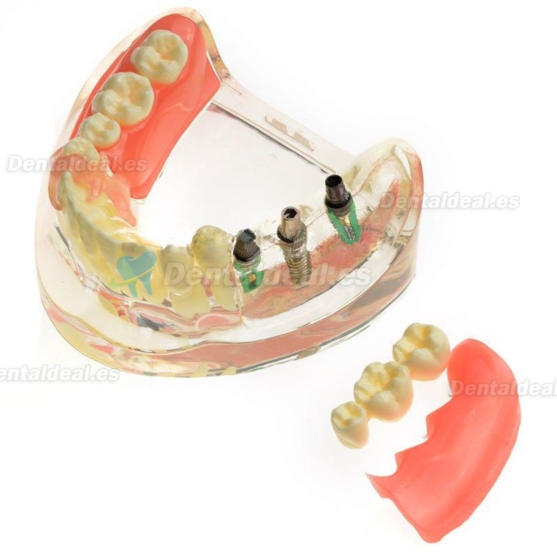 Contraste modelo dental Implante de Restauración de Missing los molares M-6006