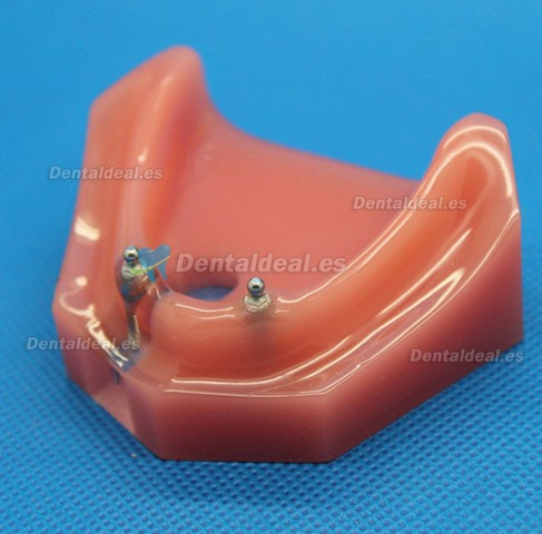 Dental Impant Modelo Para Reparación M-6007