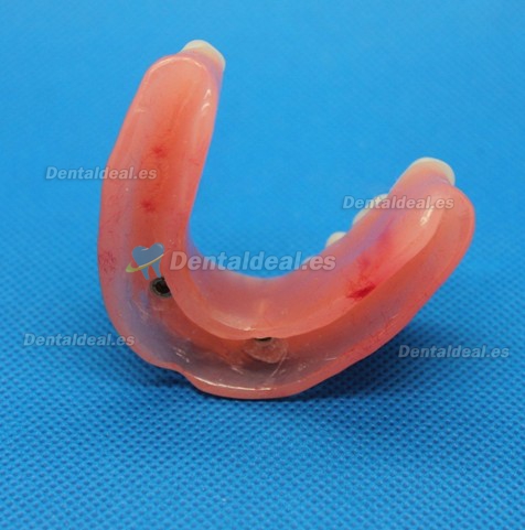 Dental Impant Modelo Para Reparación M-6007