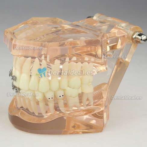 Dental Orthodontic Modelo Con Brackets M3009