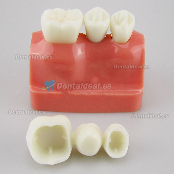 Analysis Modelo Para Dental Implant M2017