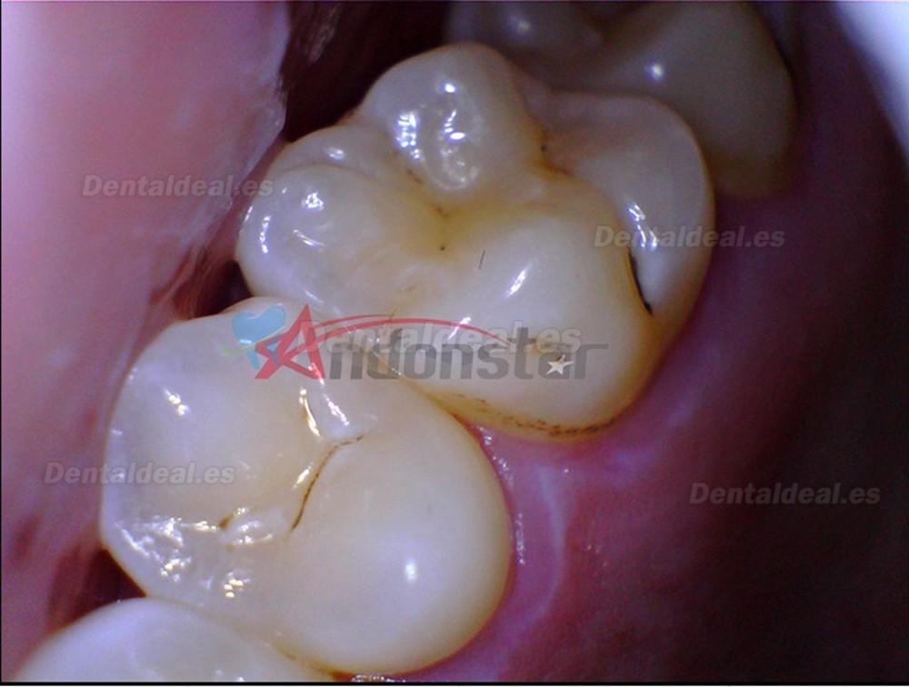 2MP Microscopio de Lápiz Dental Digital Lupa de Endoscopio USB para Microscopio Digital