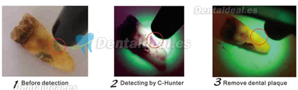 Dental Caries Detector Detección De Caries C-Hunter