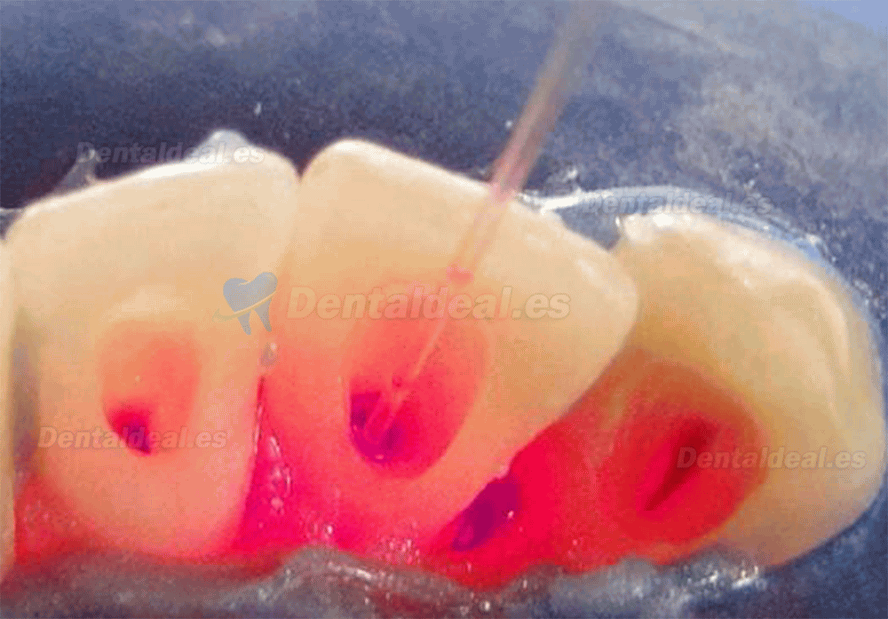 Láser de diodo dental inalámbrico Láser de tejidos blandos bolígrafo de terapia periodontal