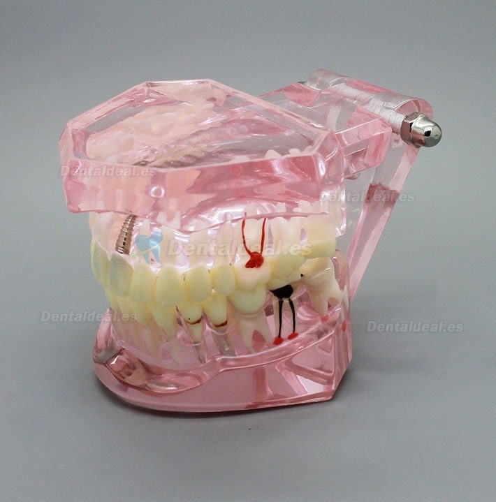 Modèle de dents de démonstration avec analyse d'étude sur implants dentaires avec restauration 2001 rose