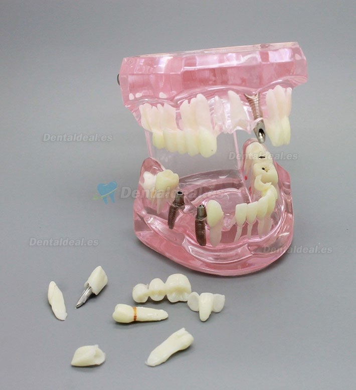 Modèle de dents de démonstration avec analyse d'étude sur implants dentaires avec restauration 2001 rose