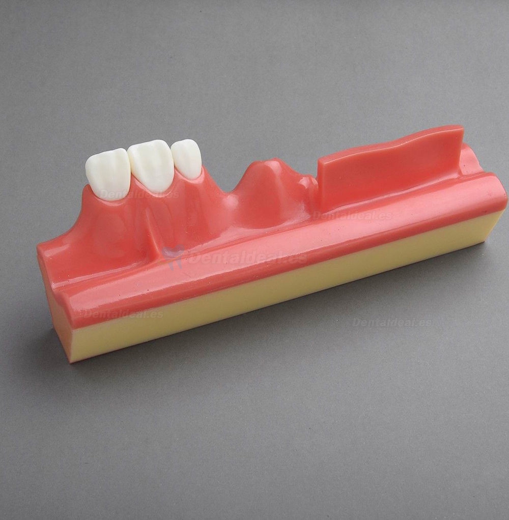 Modelo dental M-2018 etapas progresivas de un implante