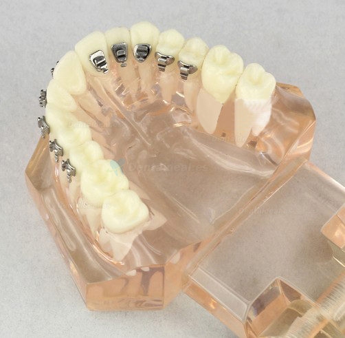 Modelo de Ortodoncia Contraste de soportes M3009