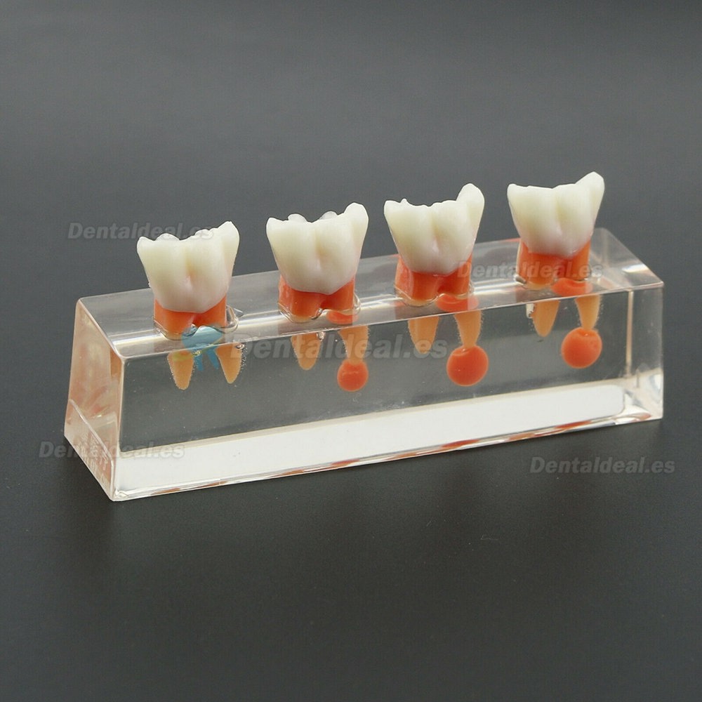 Modelo de dientes dentales El tratamiento endodóntico de 4 etapas demuestra el modelo anatómico M4018-01