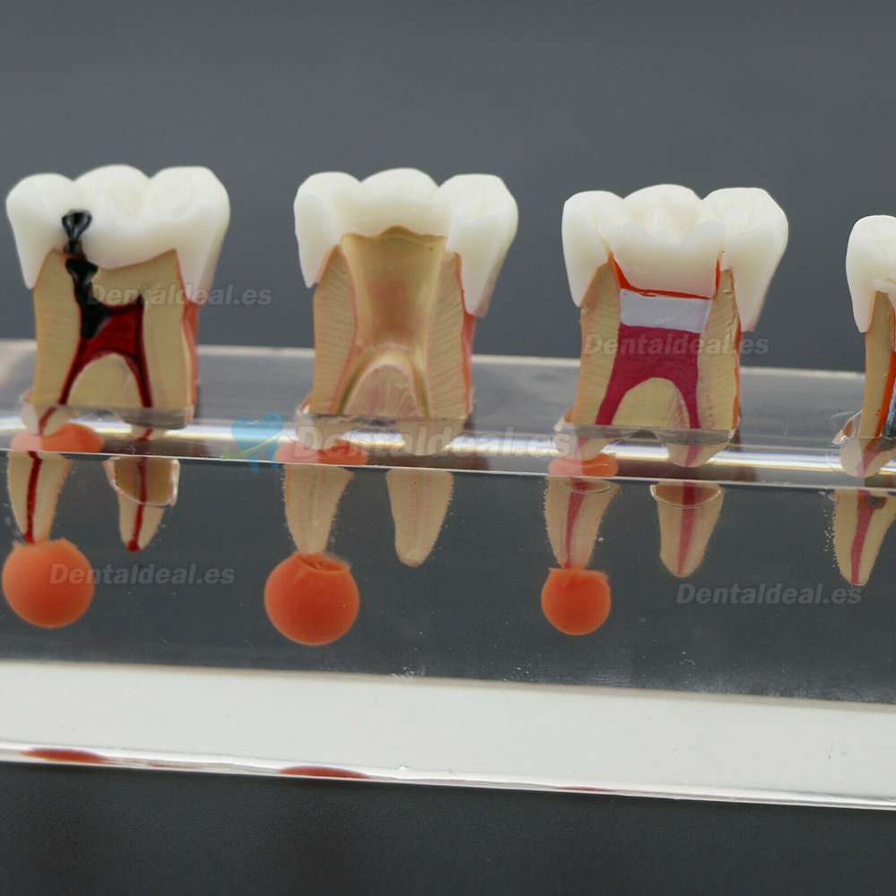 Modelo de dientes dentales El tratamiento endodóntico de 4 etapas demuestra el modelo anatómico M4018-01