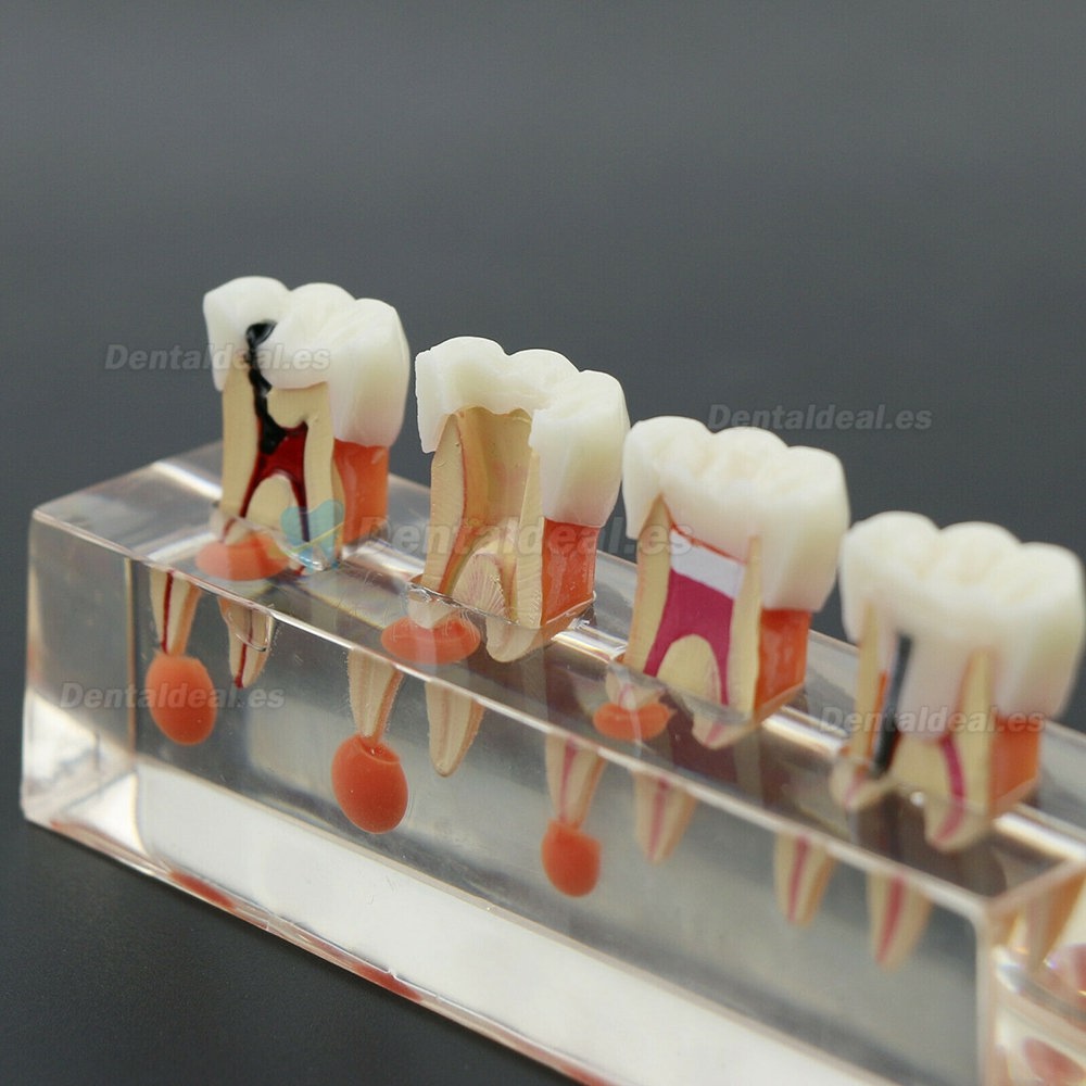 Modelo de dientes dentales El tratamiento endodóntico de 4 etapas demuestra el modelo anatómico M4018-01