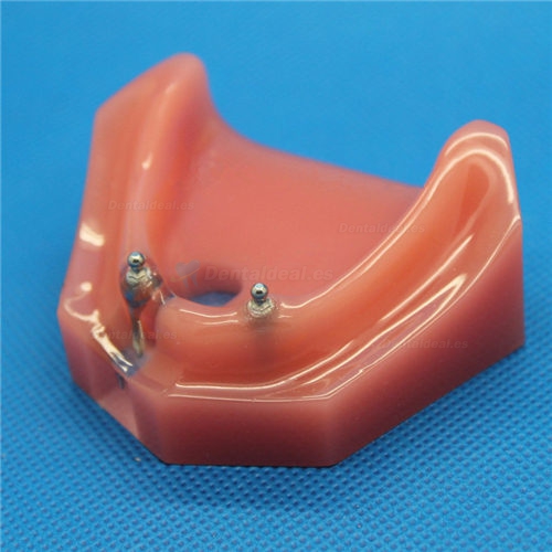 Modelo dental M-6007 Reparación del implante dental