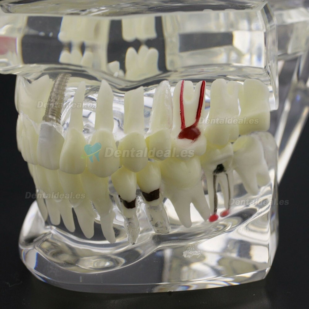 Dientes Dentales Enfermedad Modelo Implante Demostración Caries Periodoncia Transparente Rosa