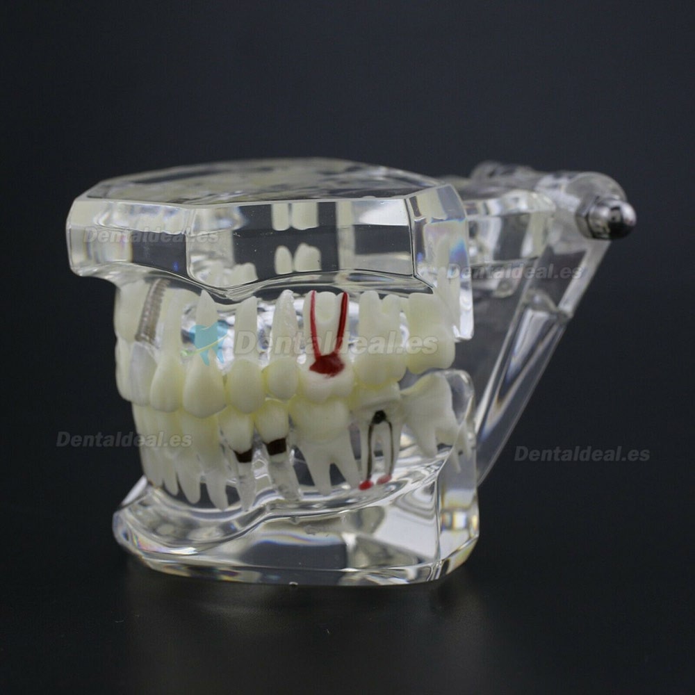 Dientes Dentales Enfermedad Modelo Implante Demostración Caries Periodoncia Transparente Rosa