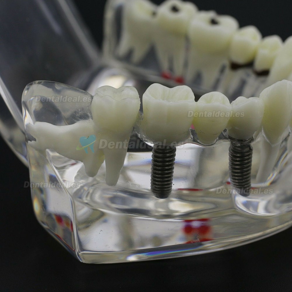 Dientes Dentales Enfermedad Modelo Implante Demostración Caries Periodoncia Transparente Rosa