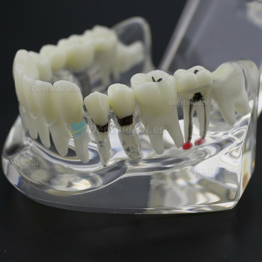 Dientes Dentales Enfermedad Modelo Implante Demostración Caries Periodoncia Transparente Rosa