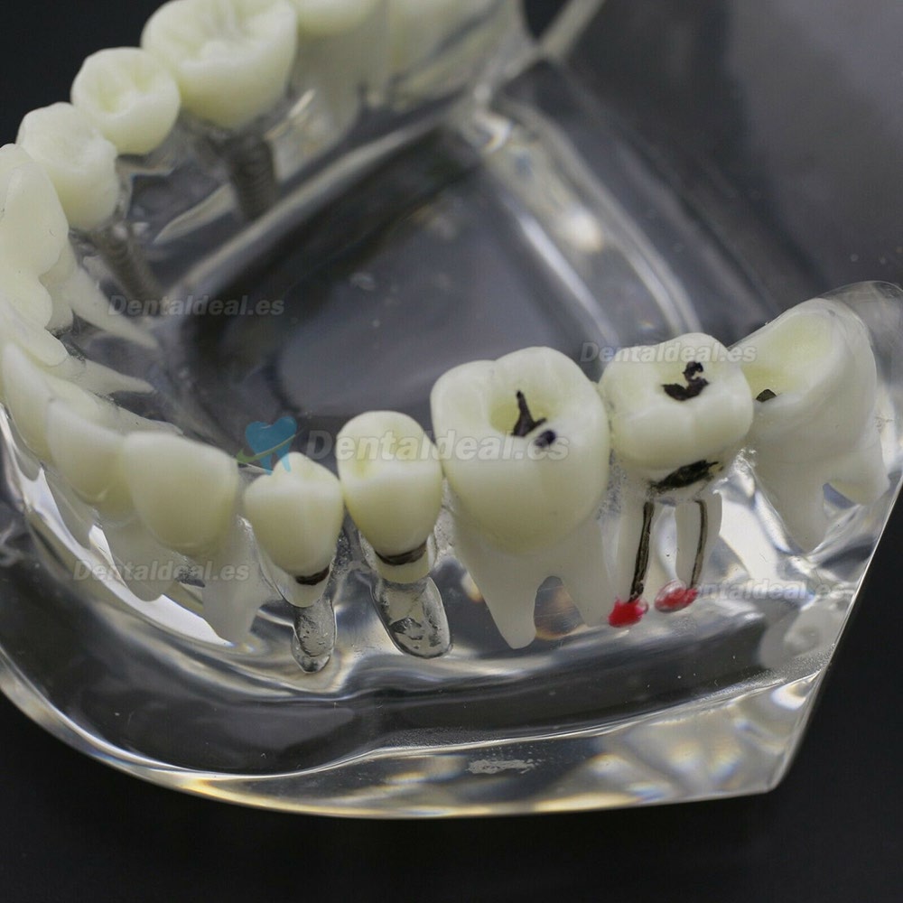 Dientes Dentales Enfermedad Modelo Implante Demostración Caries Periodoncia Transparente Rosa