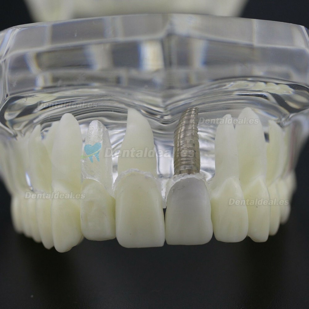 Dientes Dentales Enfermedad Modelo Implante Demostración Caries Periodoncia Transparente Rosa