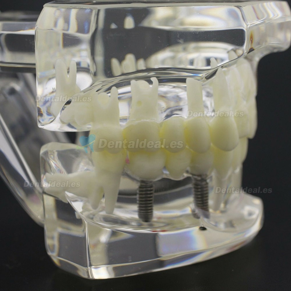 Dientes Dentales Enfermedad Modelo Implante Demostración Caries Periodoncia Transparente Rosa
