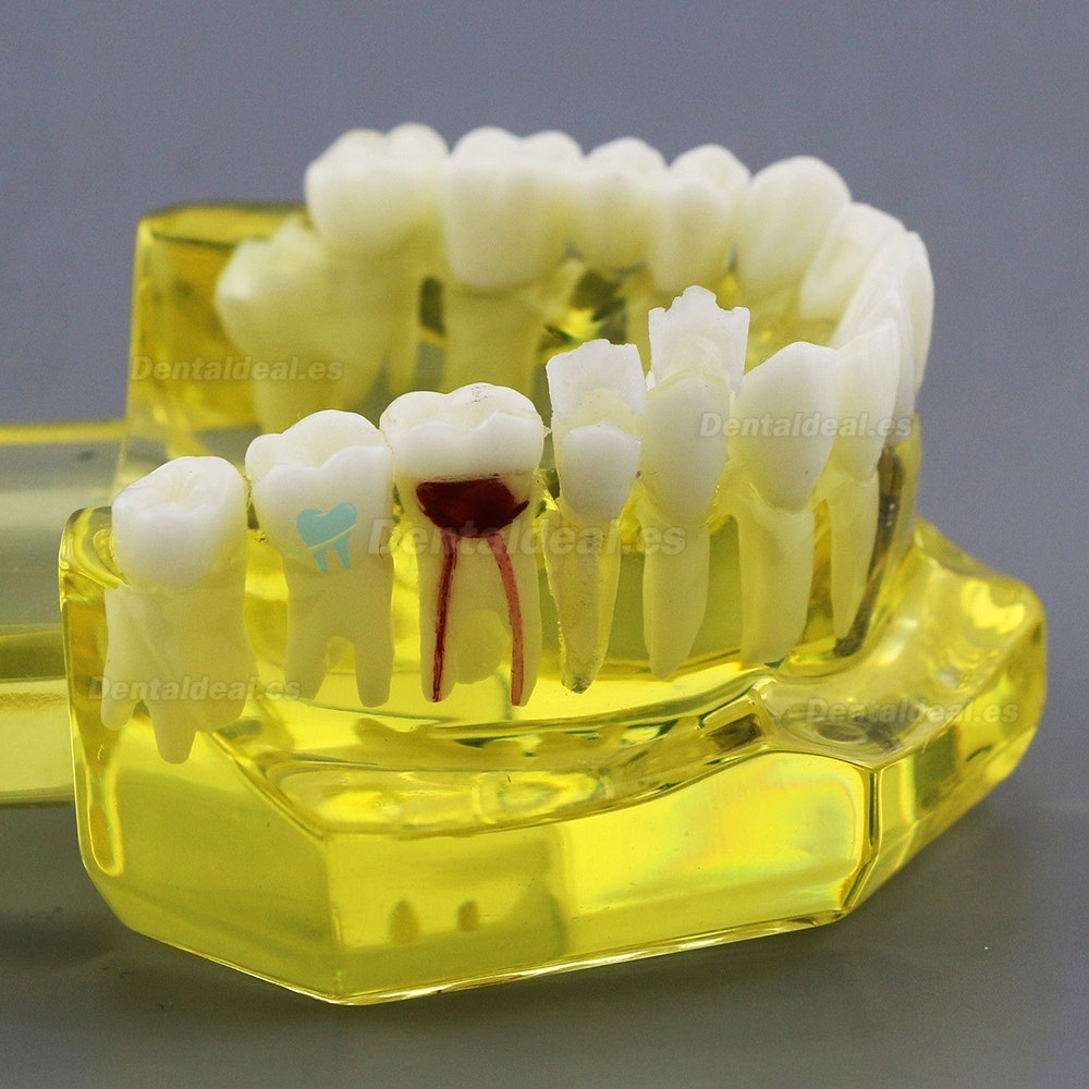 Modèle de dents dentaires Etude Teach Etude d'implantation orale Restauration et pathologie 2001 Jaune