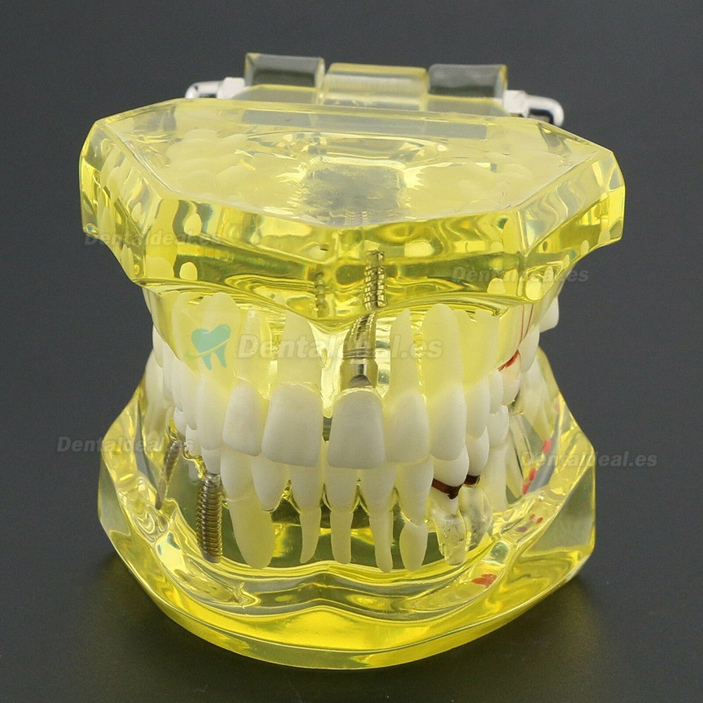 Modèle de dents dentaires Etude Teach Etude d'implantation orale Restauration et pathologie 2001 Jaune