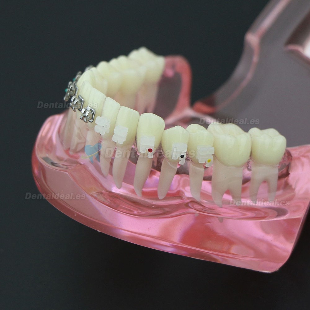 Dientes de ortodoncia dental Modelo de metal y soporte de cerámica Braces estudio modelo 3003