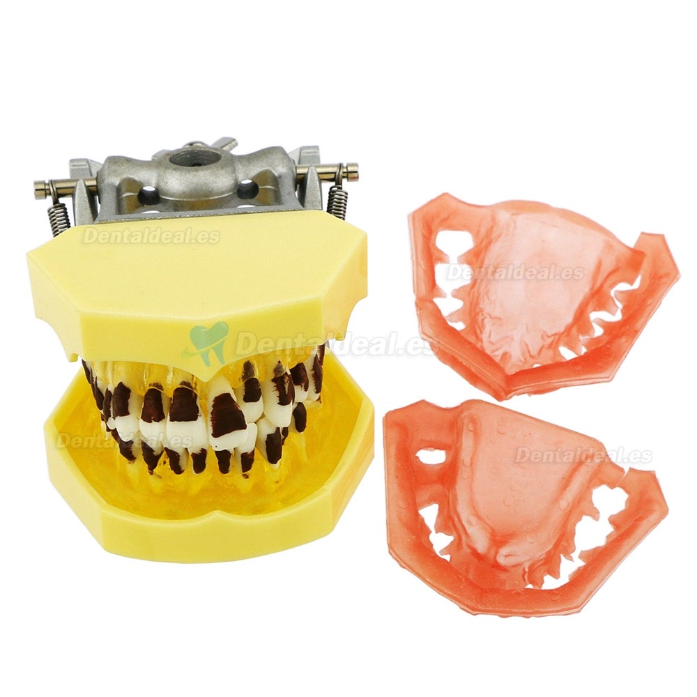 Modelo de enfermedad de periodontosis dental demuestra inflamación gingivale calculs 4003