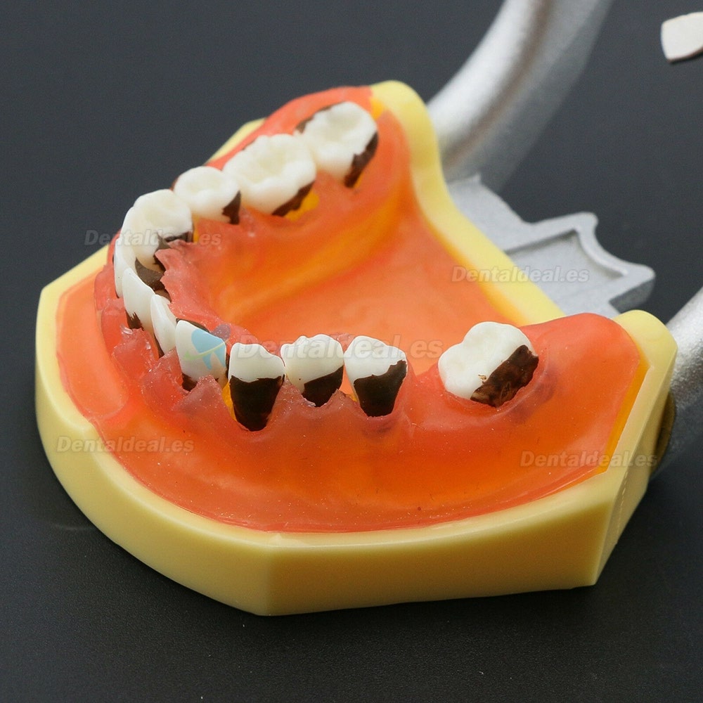 Modelo de enfermedad de periodontosis dental demuestra inflamación gingivale calculs 4003